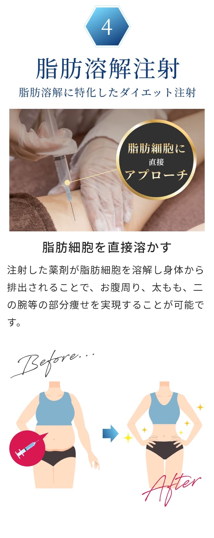 脂肪溶解注射